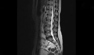 Degenerative Disc Disease X-Ray