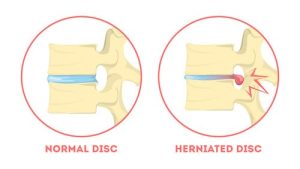 Normal Disc & Herniated Disc