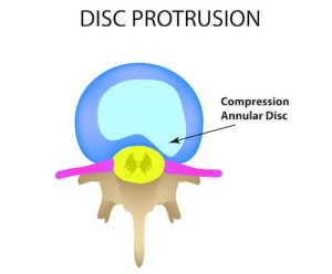 Disc Protrusion