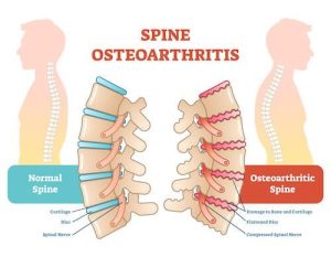 Spine Osteoarthritis