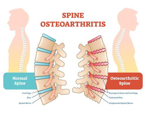 https://www.downtownpainphysicians.com/wp-content/uploads/2020/11/Lumbar-Radiofrequency-Ablation-RFA.jpg