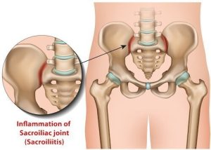 Sacroiliac Joint Injections