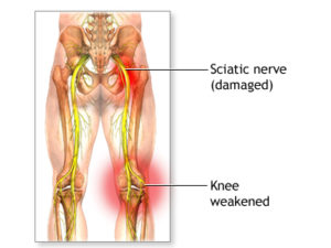 Sciatic Nerve Pain During Pregnancy - Penn Medicine Lancaster General Health