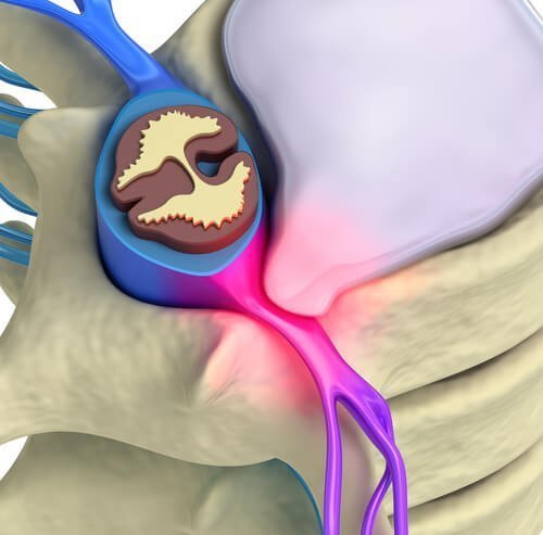 Spinal Cord Stimulator - Center for Interventional Pain & Spine