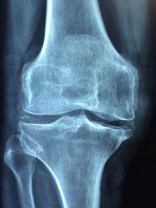 Osteoarthritis