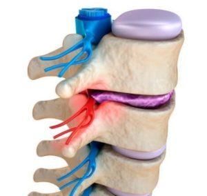 Endoscopic Discectomy Procedure