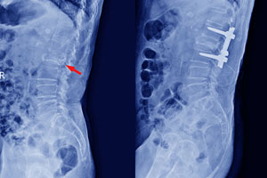 Degenerative-disc-disease