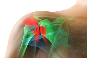 Rotator Cuff Injury