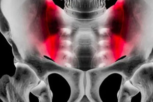 Sacroiliac Joint Dysfunction