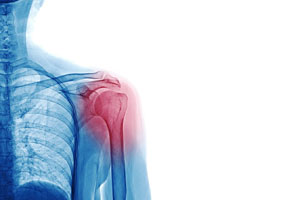 Shoulder-tendonitis