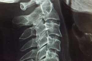 Spondylolisthesis