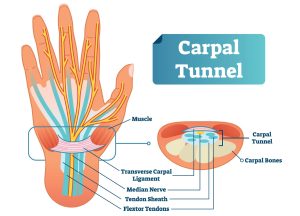 Carpal Tunnel Syndrome