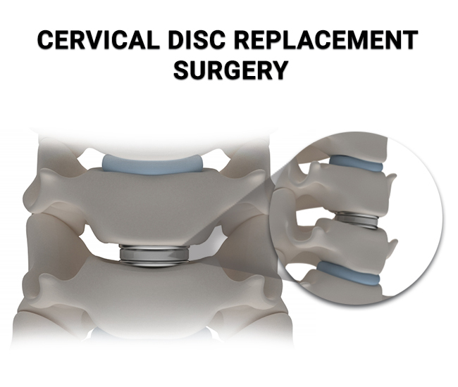 Cervical Disc Replacement Surgery