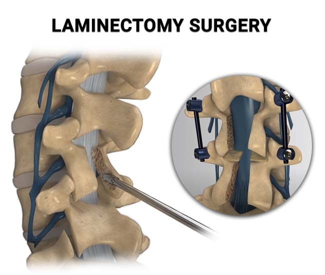 Hemilaminectomy Surgery