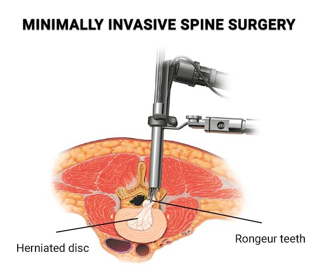 Minimally Invasive Spine Surgery