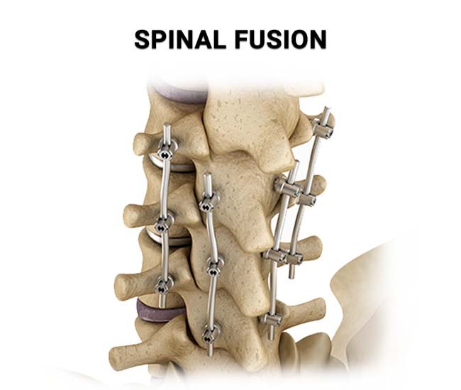 Spinal Fusion Surgery