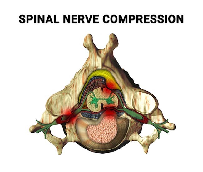 Spinal Nerve Compression
