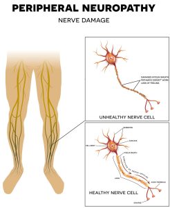 peripheral neuropathy